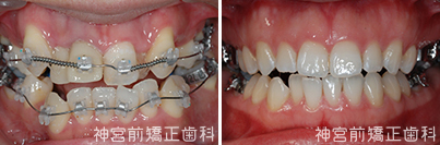 審美的歯科矯正法: 舌側矯正臨床基本テクニック 裏側矯正（舌側矯正）の真実｜見えないだけじゃない、その治療の難し